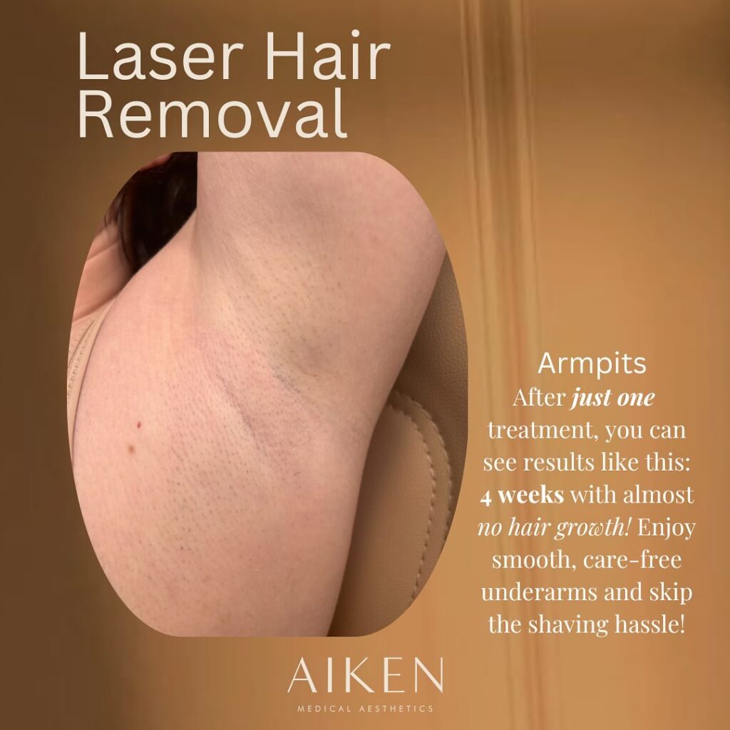 Say goodbye to stubborn underarm hair with Laser Hair Removal in Aiken